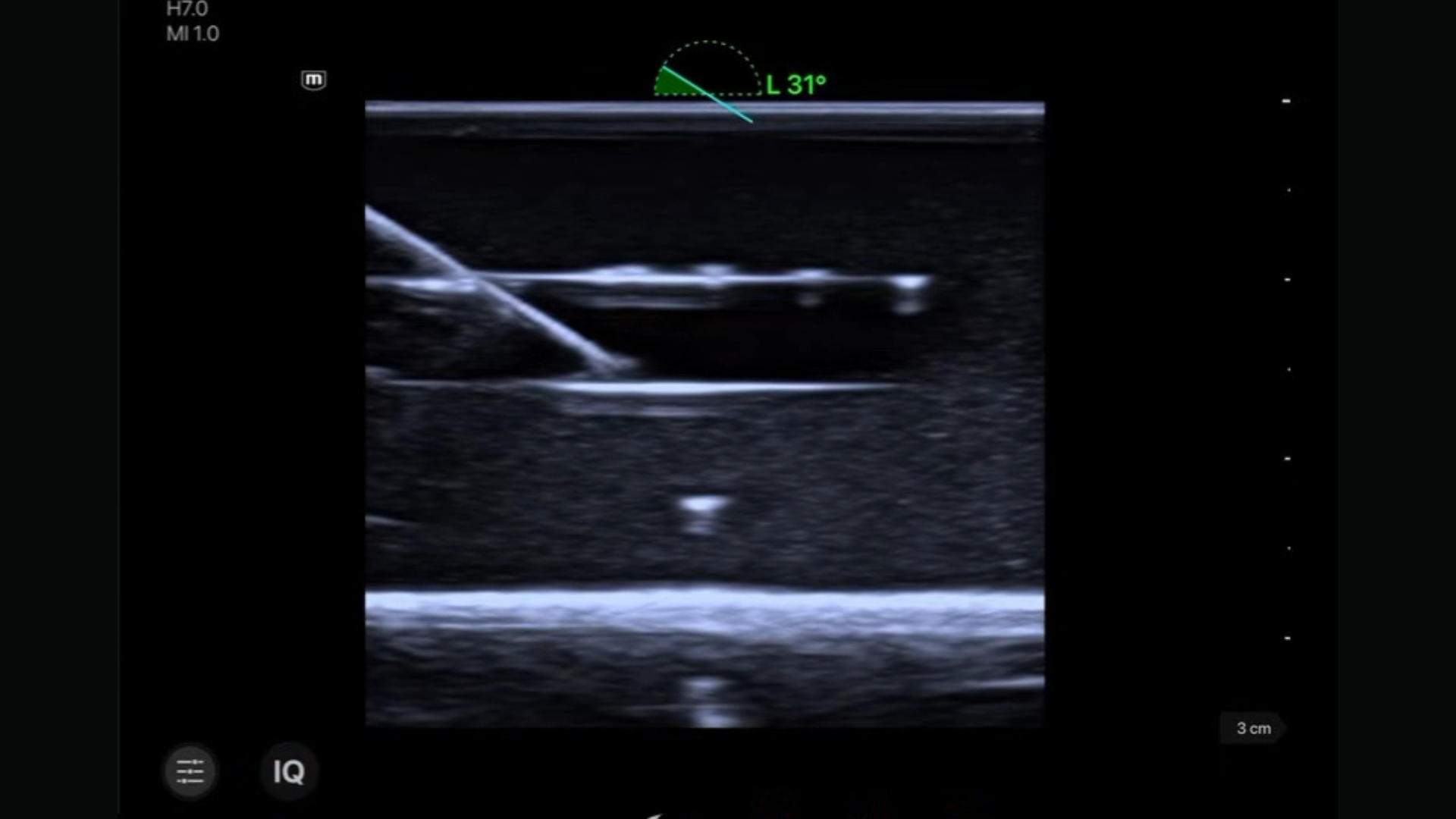 needle enhancement technology on portable ultrasound ineedle