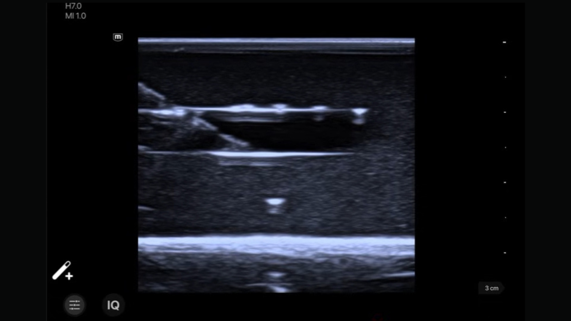 needle enhancement technology off portable ultrasound ineedle