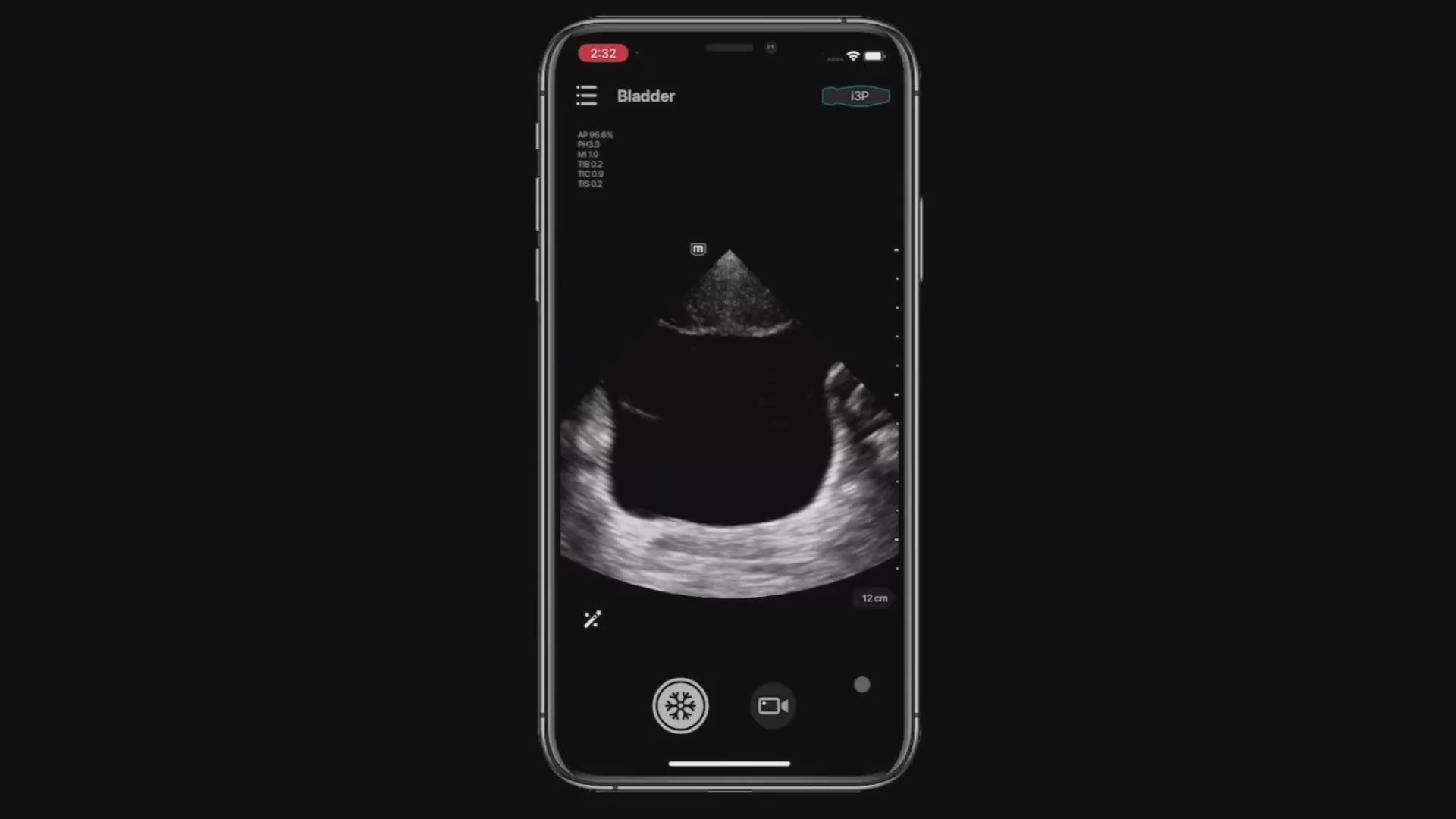 Smart Bladder,Bladder volume auto calculated with TE Air portable ultrasound
